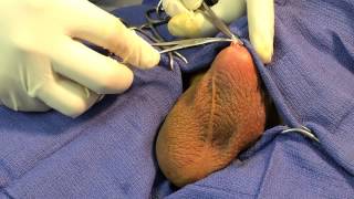 No Scalpel Vasectomy