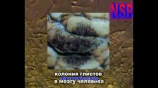 Почему не надо делать ВАКЦИНУ «ПРОТИВ» РАКА ШЕЙКИ МАТКИ.