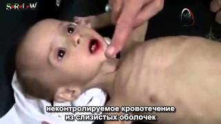 СИРИЯ ДЕТИ УМИРАЮТ ОТ ГОЛОДА