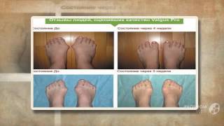 фиксатор вальгус про отзывы

  - Valgus Pro - против шишек на ногах.