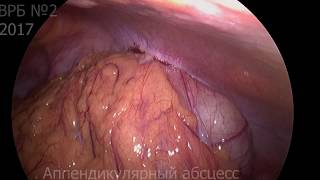 Аппендикулярный абсцесс