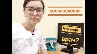 КОЛЬПОСКОПИЯ - что это? Что видит врач на приеме?
