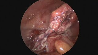 Acute appendicitis, ruptured appendix base