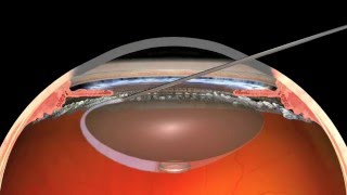 Victus Femtosecond Laser Cataract Surgery and Translens Hydrodissection