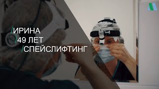 Спейслифтинг. История Ирины 49 лет