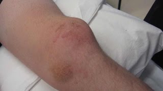 Перелом ноги на квадропробеге