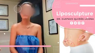 LIPOESCULTURA, LIPOSUCCIÓN