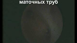 Проходимость маточных труб идеальная!