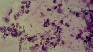 Gynaecology. Cervix. Cervicitis. Phagocytosis.