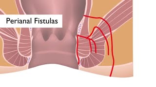Spotlight on Perianal Fistulas Research | Johns Hopkins Meyerhoff IBD Center