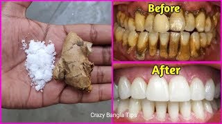 আদার সাথে কয়েকটি উপাদান মিশিয়ে মাত্র ২ মিনিটে হলুদ দাঁত সাদা করার উপায়।Teeth Whitening Best Remedy
