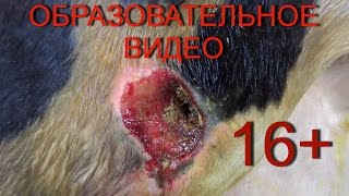 Хирургическое лечение пролежня.16+ Surgical treatment of pressure ulcers.