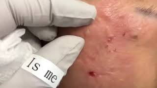 Acne! Огромные угри! Давим! Огромные прыщи!
