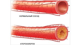 Холестерин. Надо ли статины?
