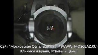 Лазерная коррекция близорукости (миопии) - видео операции