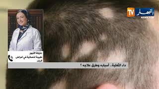 داء الثعلبة ..أسبابه وطرق علاجه !!