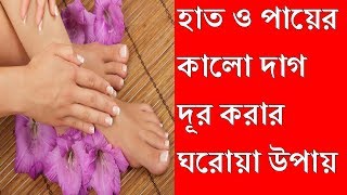 হাত ও পায়ের কালো দাগ দূর করার ঘরোয়া উপায়