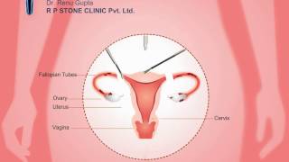 Animation of Total Laparoscopic Hysterectomy