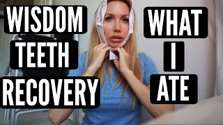 WISDOM TEETH RECOVERY + WHAT I ATE