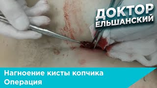 Нагноение кисты копчика операция