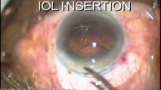 Extra capsular cataract extraction (ECCE) surgery