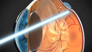 Retinal Consultants of Arizona - Retinal Tears & Detachments