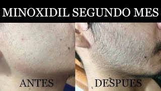 ¿Funcionaria el minoxidil en un lampiño? Segundo mes
