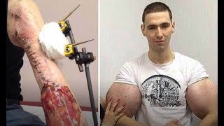 РУКИ-БАЗУКИ ОТРЕЗАЛИ!? - АМПУТАЦИЯ РУК-БАЗУК!