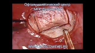 Непроникающая глубокая склерэктомия (НГСЭ) - видео операции при глаукоме