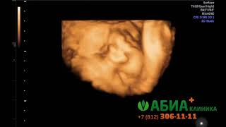 3D УЗИ, 38 недель. Малыш спит.