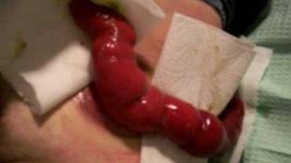 Prolapsed Ileostomy Stoma Care (6 of 10)