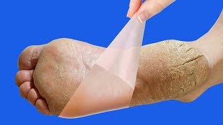 1 GECEDE TOPUK ÇATLAKLARINDAN KURTUL - Topuk Çatlağı Nasıl Geçer ? Yumuşak Ayaklar - Cilt Bakımı
