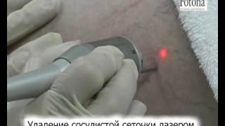 Удаление сосудистой сеточки лазером