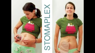 Ostomy Bag - Ostomy Care - Leak Prevention - Video - Stomaplex Equalizer #ostomytips #ostomy