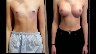 Результаты увеличения груди - ЧАСТЬ 4 ★ Breast Augmentation results - PART 4