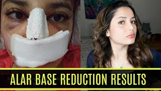 Nose Job 9 Months Post Op | Alar Base Reduction Results
