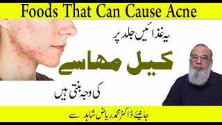 Foods That Causes Acne And Pimples