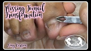 ?Pedicure Tutorial Missing Toenail Reconstruction with Acrylic Transformation?✔️