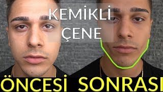Keskin Yüz Hatları ve Kemikli Çeneye Nasıl Sahip Olunur? - MEWİNG?