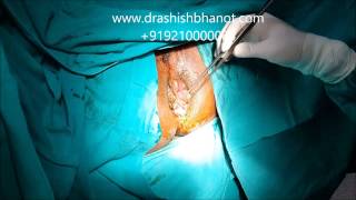 Ignored Piles Best Treatment - Dr Ashish Bhanot