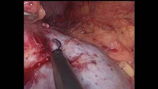 Lap left partial nephrectomy - HOW I DO IT!
