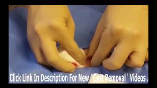 Removing Small Cysts on The Back   YouTube