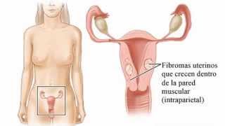 Tratamiento natural para Mioma o fibroma uterino y quiste