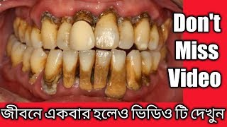 ১০০% গ্যারান্টি দাঁত হবে চকচকে সাদা। বিশ্বাস না হলে একবার দাঁতে লাগিয়ে দেখুন। Sanjida Beauty Tips