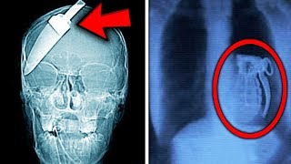 Top 10 Most Shocking THINGS FOUND IN X-RAYS!