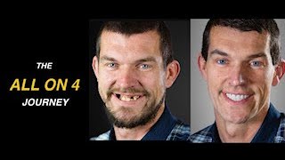 All on 4 Patient Journey | Amazing Transformation
