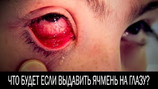 Что будет если выдавить ячмень на глазу