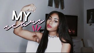 MY SKIN DISEASE AND SCARS ♡ Storytime