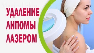 Удаление липомы лазером