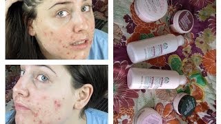 Week 2, Day 12 Accutane Update | New Skincare Routine!